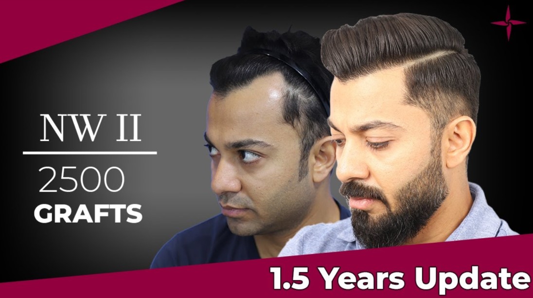 Hair Transplant Clinic in India