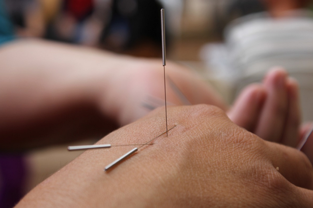 Best Acupuncture in Oklahoma City