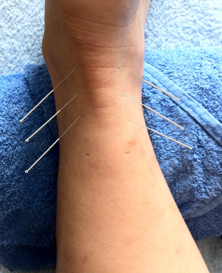 One of the best Acupuncture in Tucson