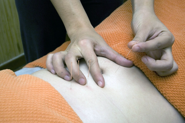Top Acupuncture in Milwaukee
