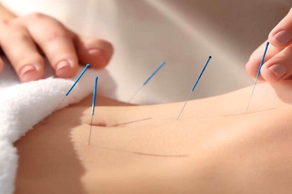 Acupuncture in Omaha