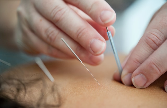 5 Best Acupuncture in Kansas City