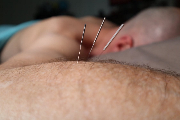Best Acupuncture in Long Beach