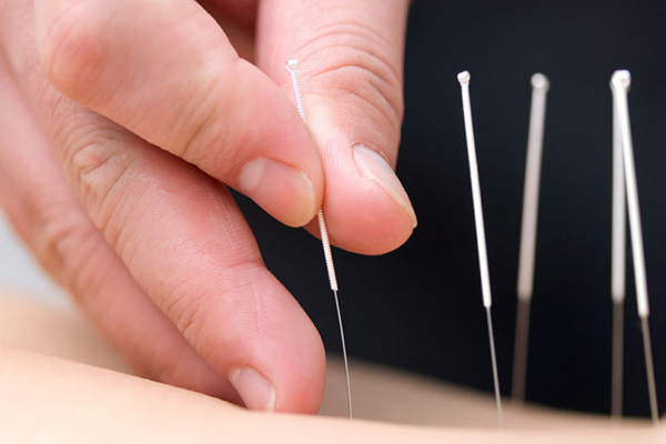 One of the best Acupuncture in Virginia Beach