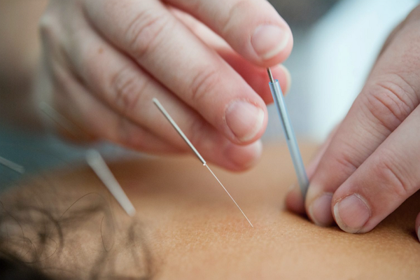 Top Acupuncture in Bakersfield