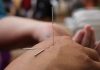 5 Best Acupuncture in Oakland, CA